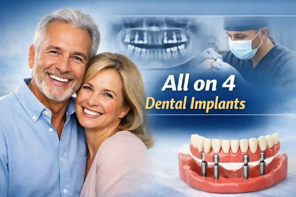 All-on-4 Implant