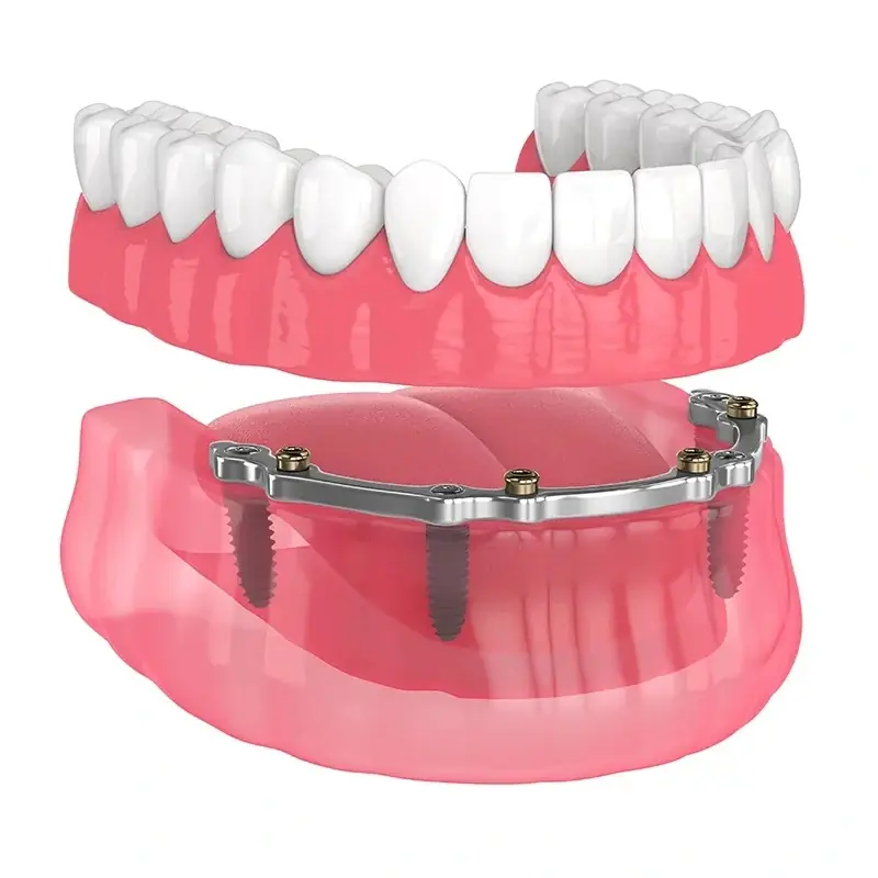 All-on-4 Implant