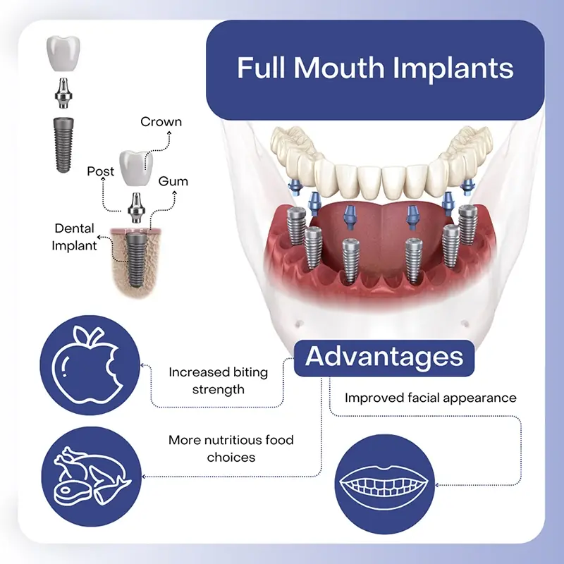 Full Mouth Dental Implant