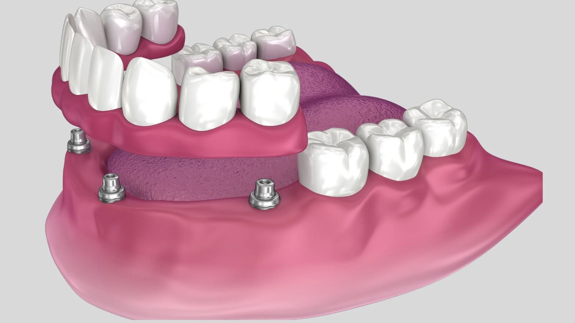 All-on-4 Dental Implant Technique