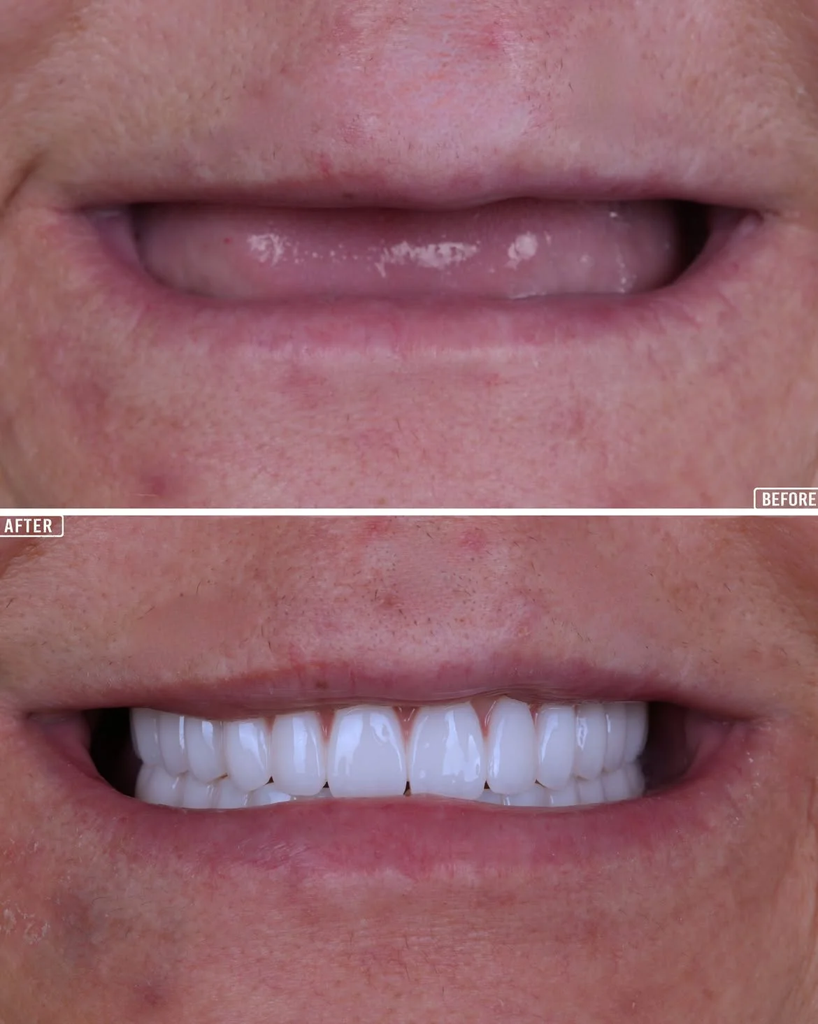 All-on-4 Before & After 4