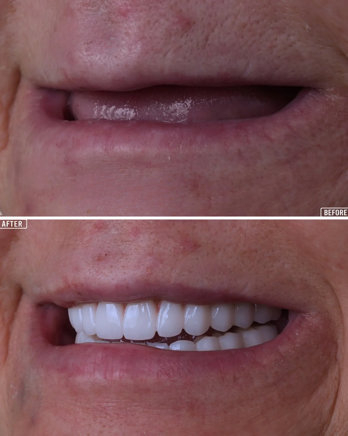 All-on-4 Before & After 5