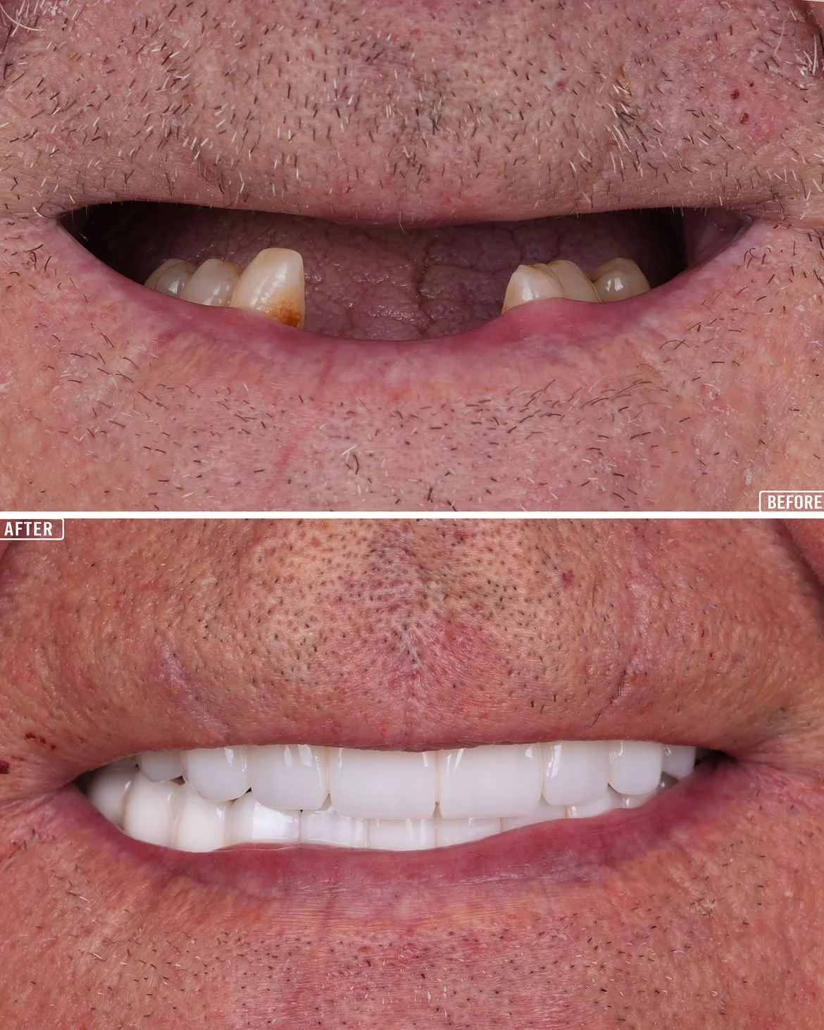 All-on-4 Before & After 9