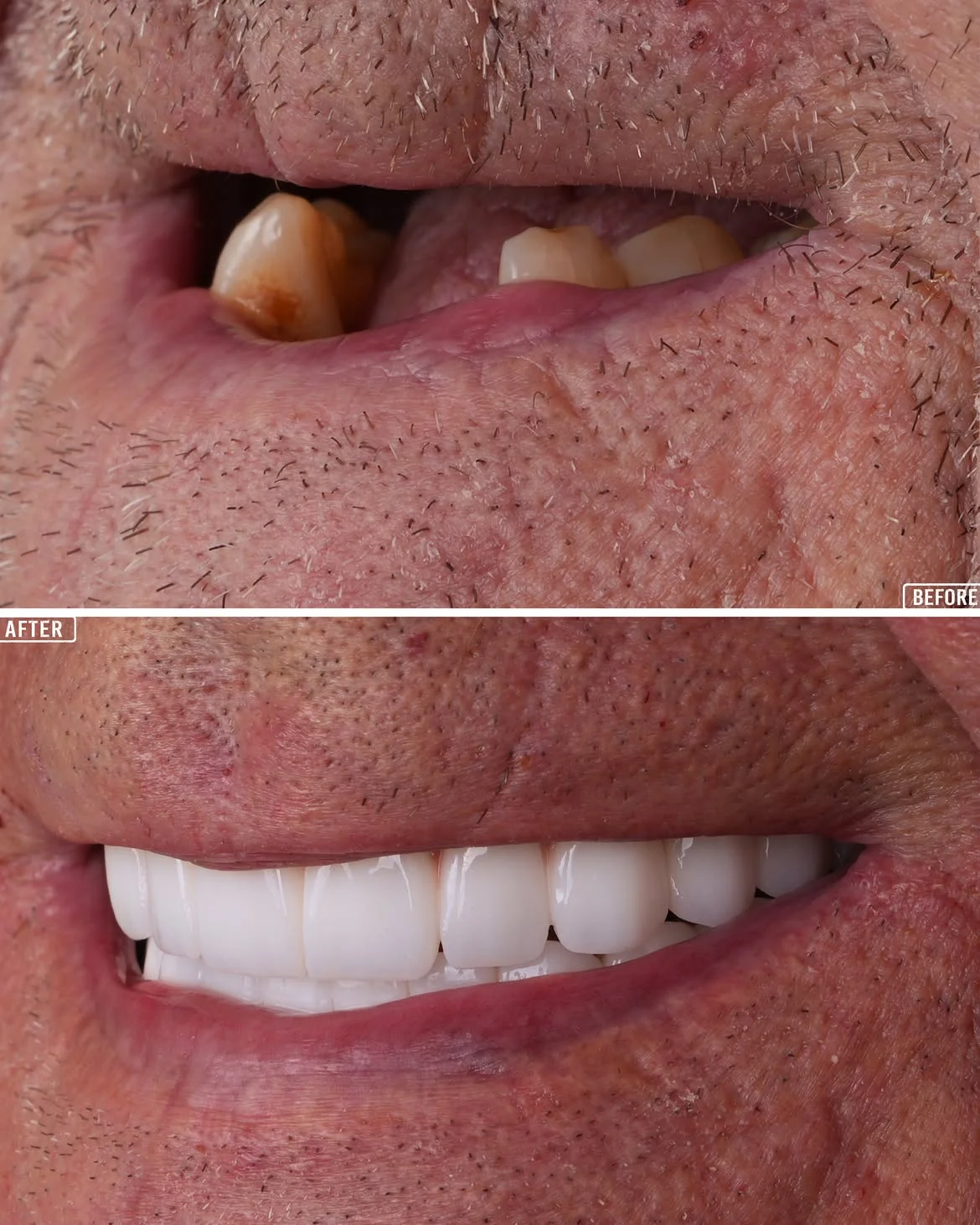 All-on-4 Before & After 10