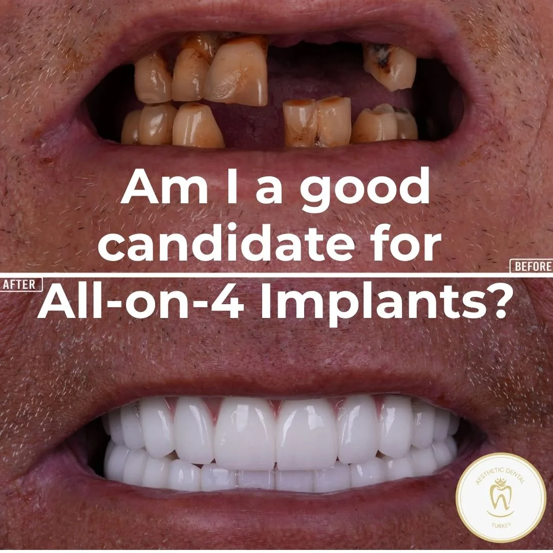am-i-good-a-good-candidate-for-all-on-4?