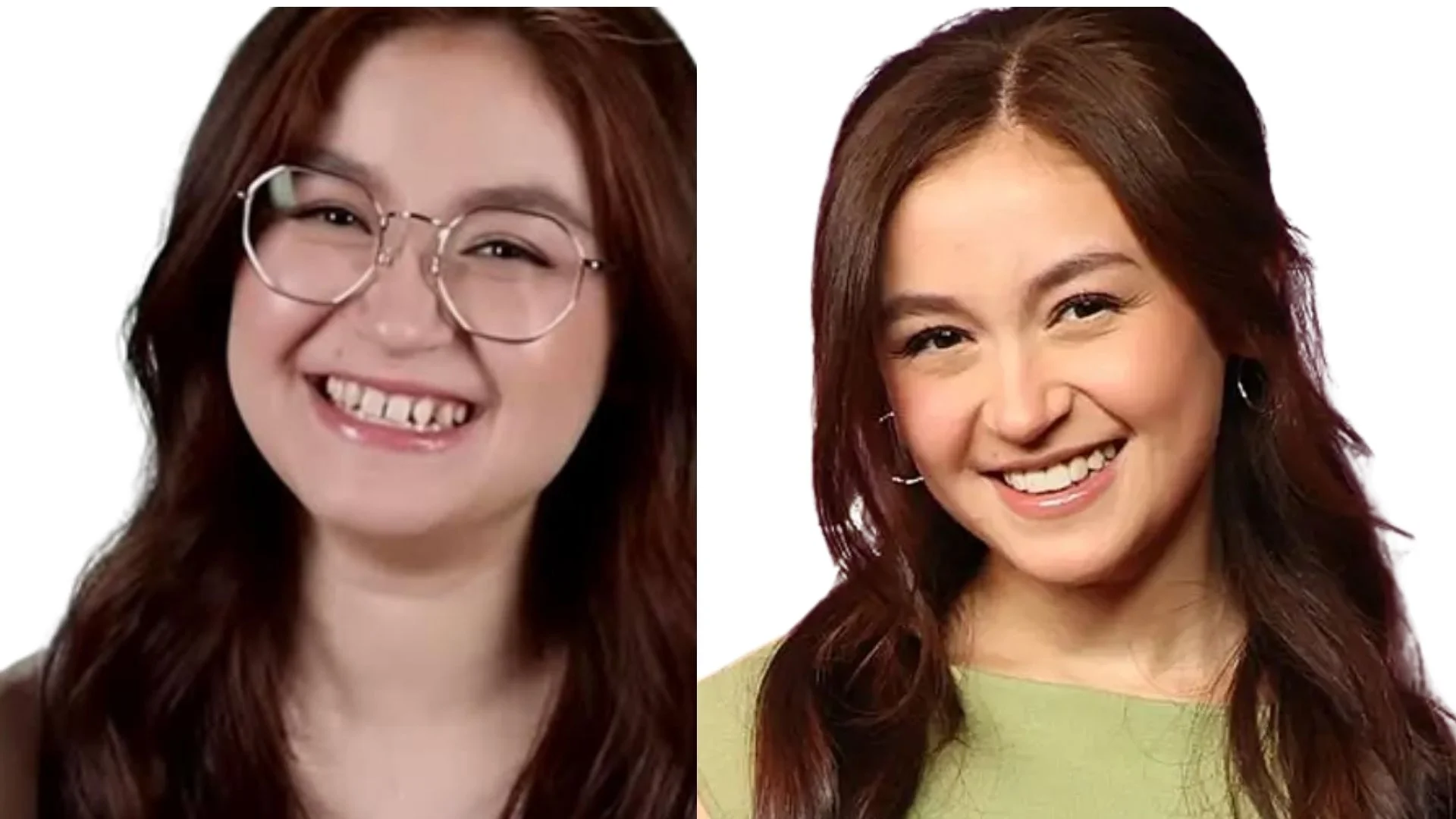 Did Anna have veneers treatment? 