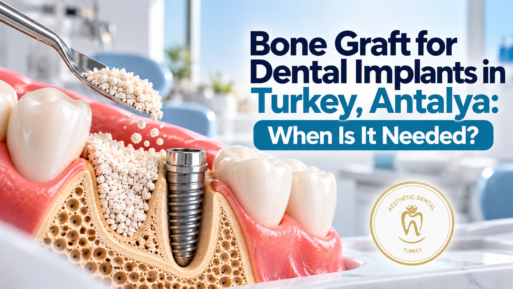 Bone Graft for Dental Implants in Antalya, Turkey: When Is It Needed?