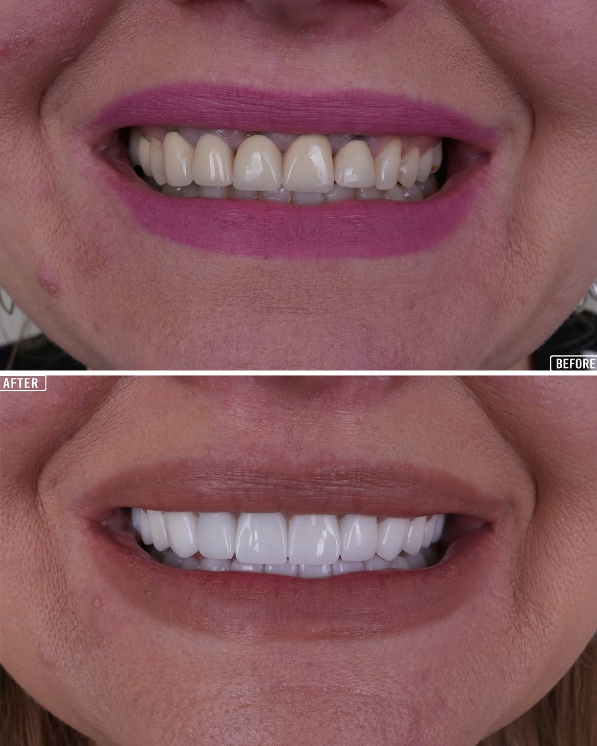 Old Dental Crowns Replaced with New Crowns Before and After in Antalya, Turkey