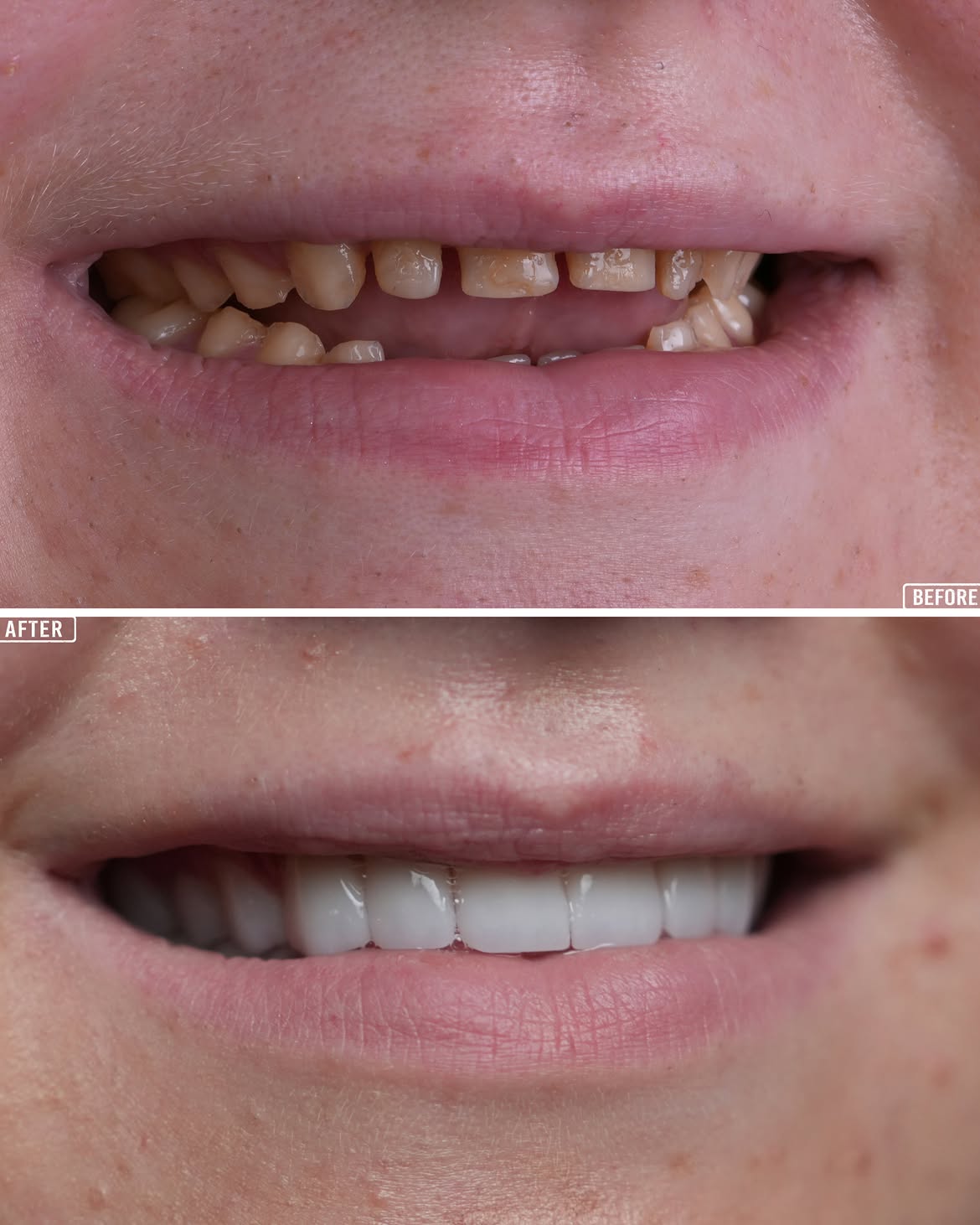 Dental Crown Treatment Before and After