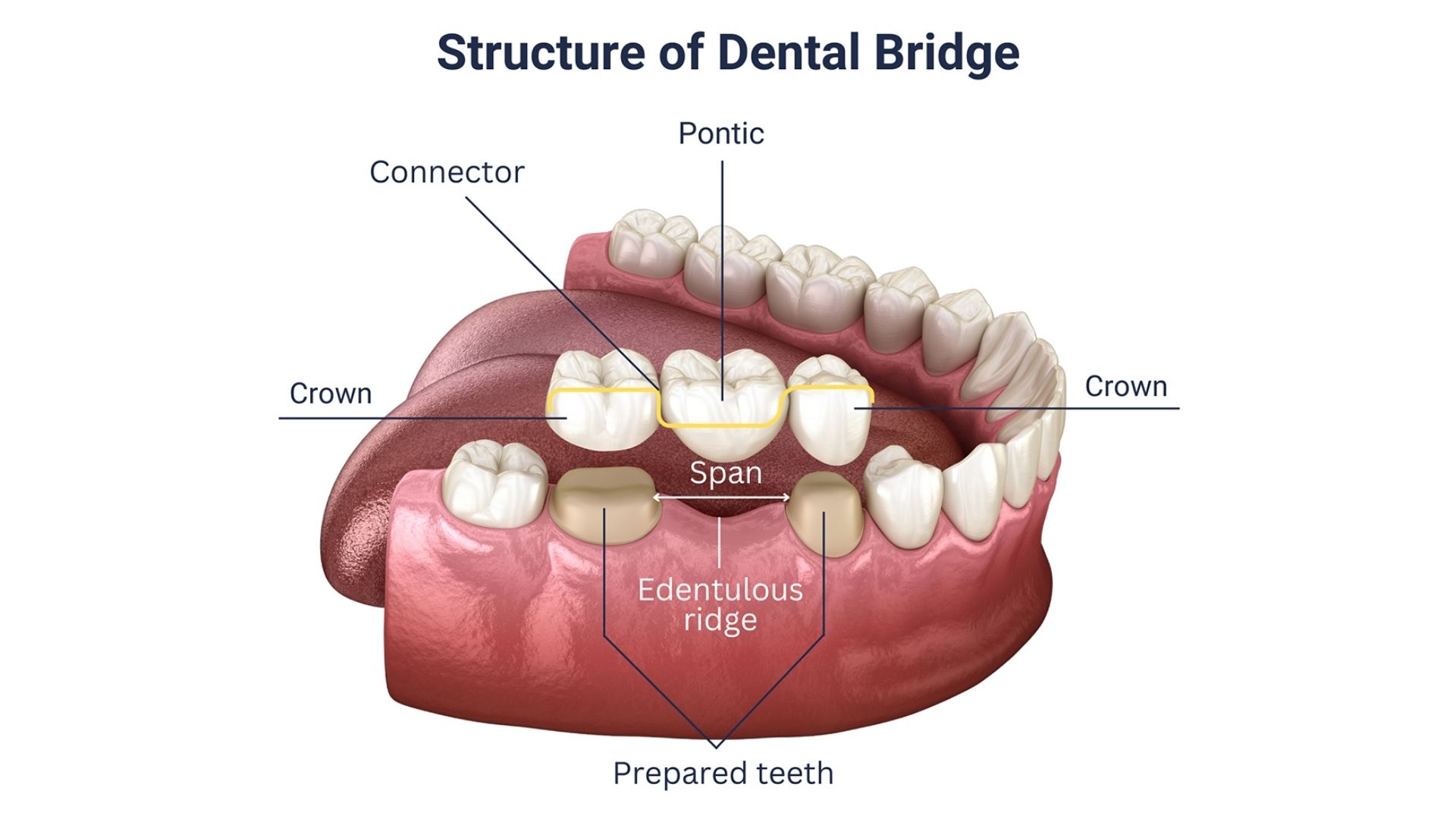 Dental Bridge 
