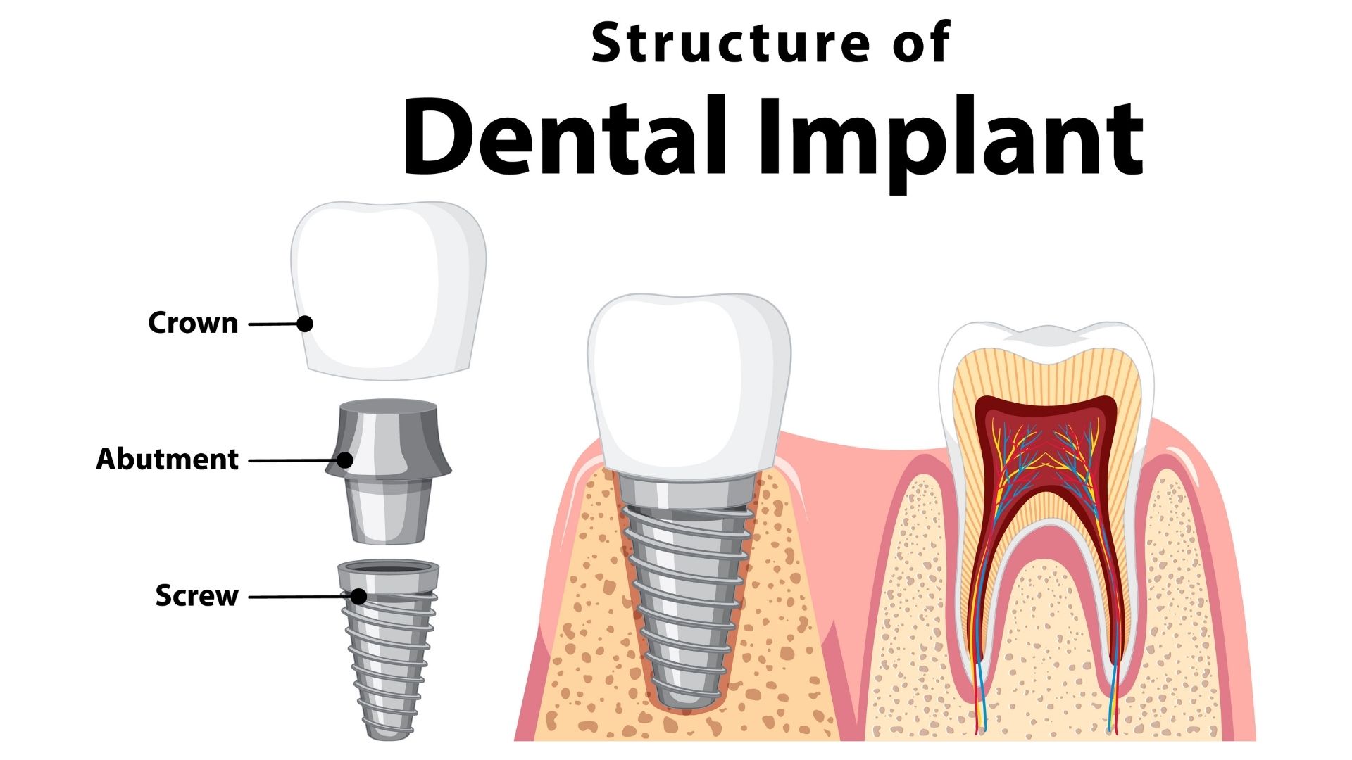 Dental Implant 