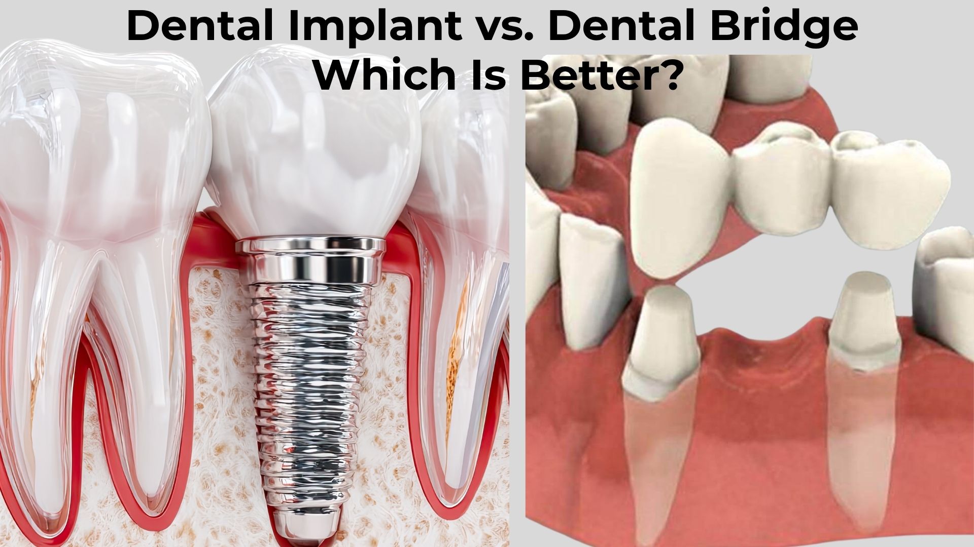Dental Implant vs Dental Bridge: Which Is Better? 
