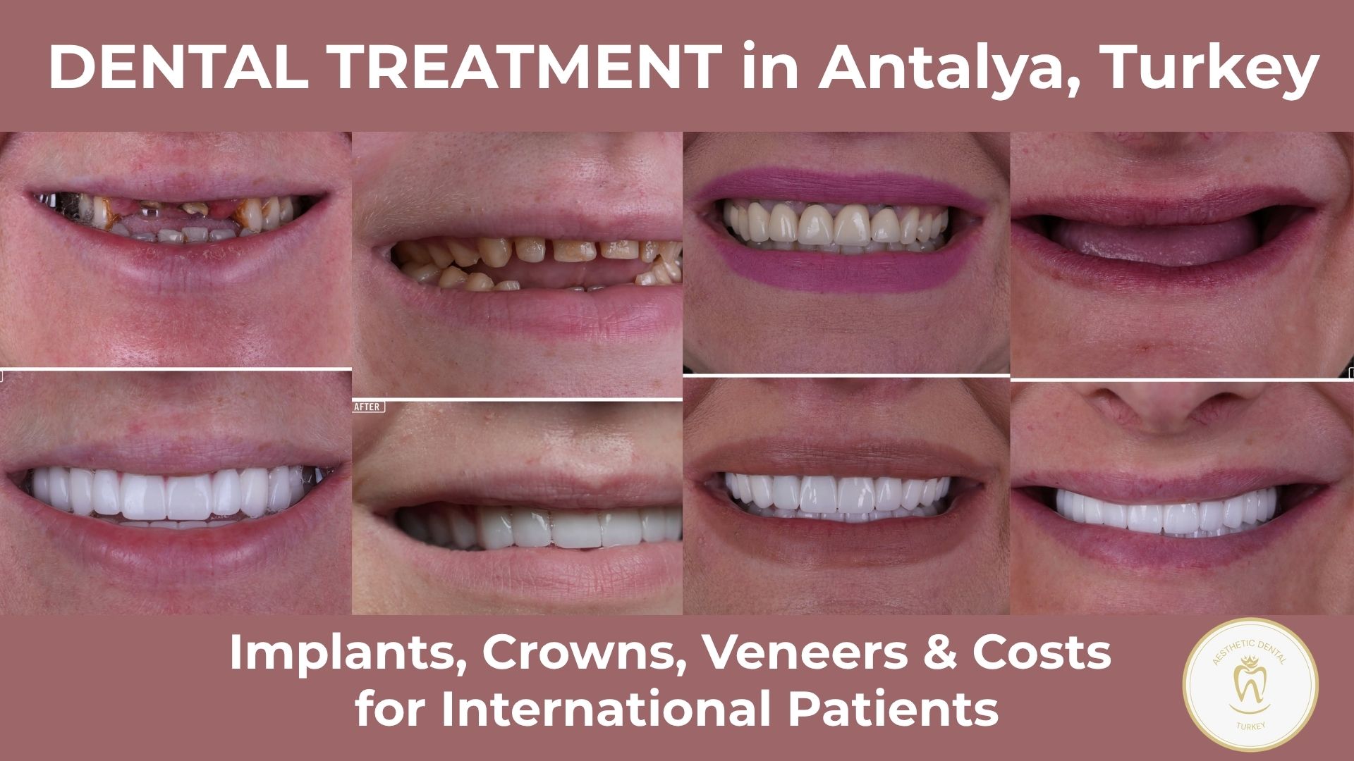 Dental Treatment in Antalya, Turkey: Implants, Crowns, Veneers and Costs