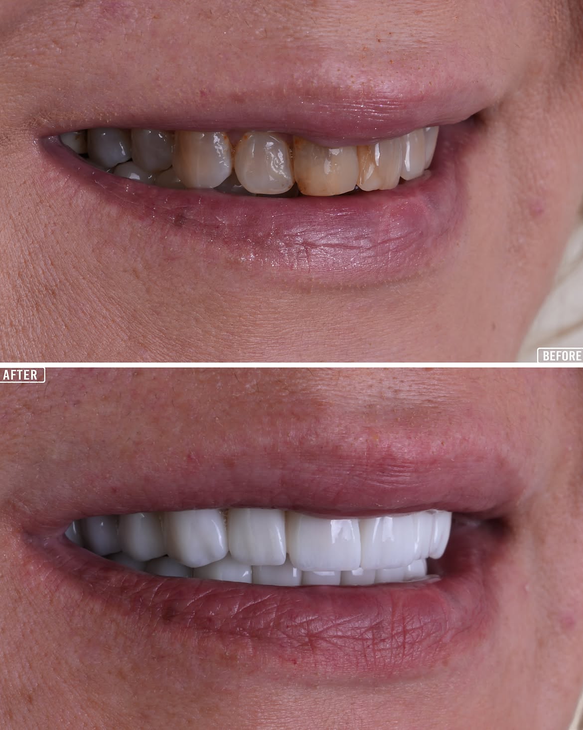 Dental Veneer Treatment Before and After in Antalya, Turkey