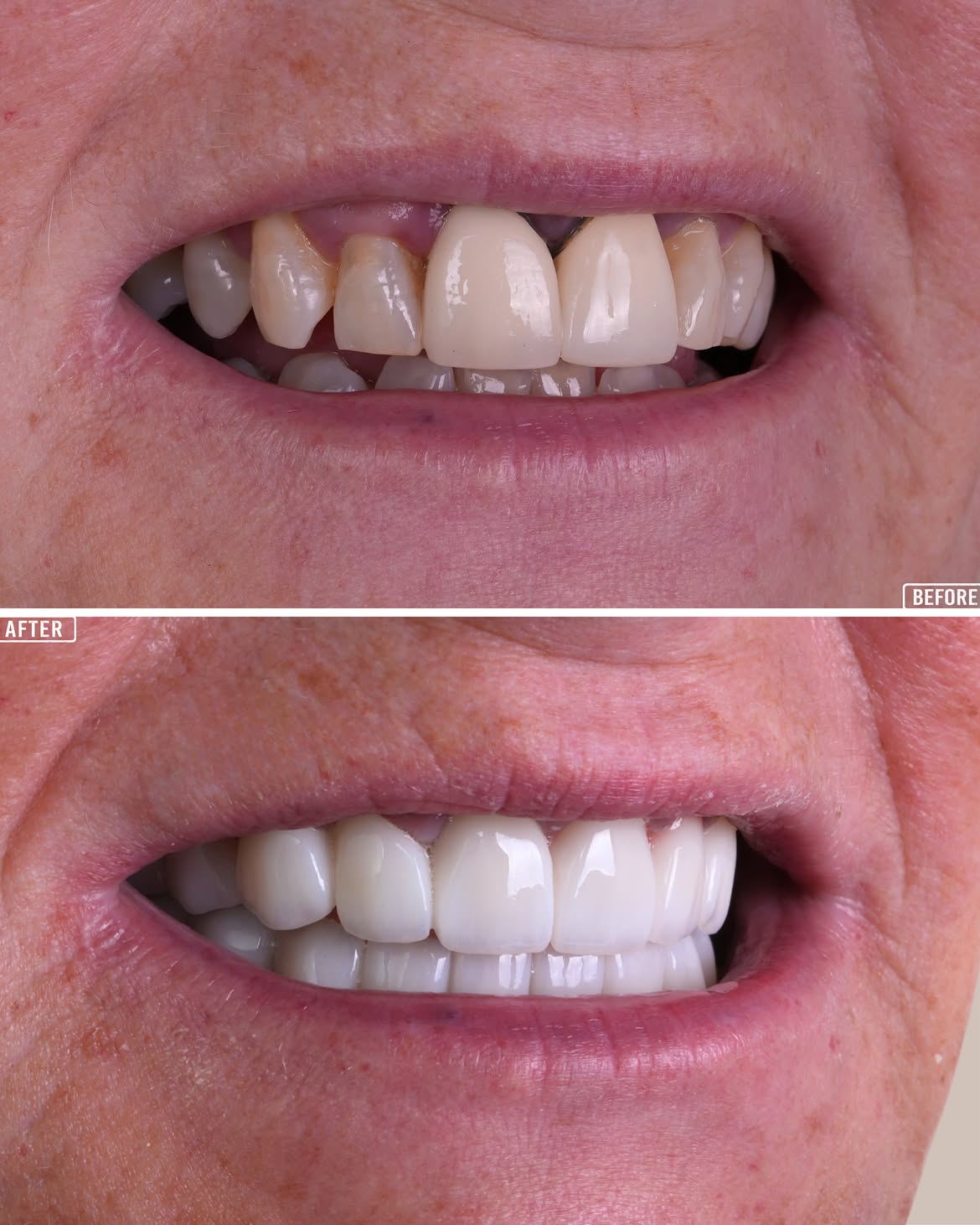 Dental Veneer Treatment Before and After in Antalya, Turkey