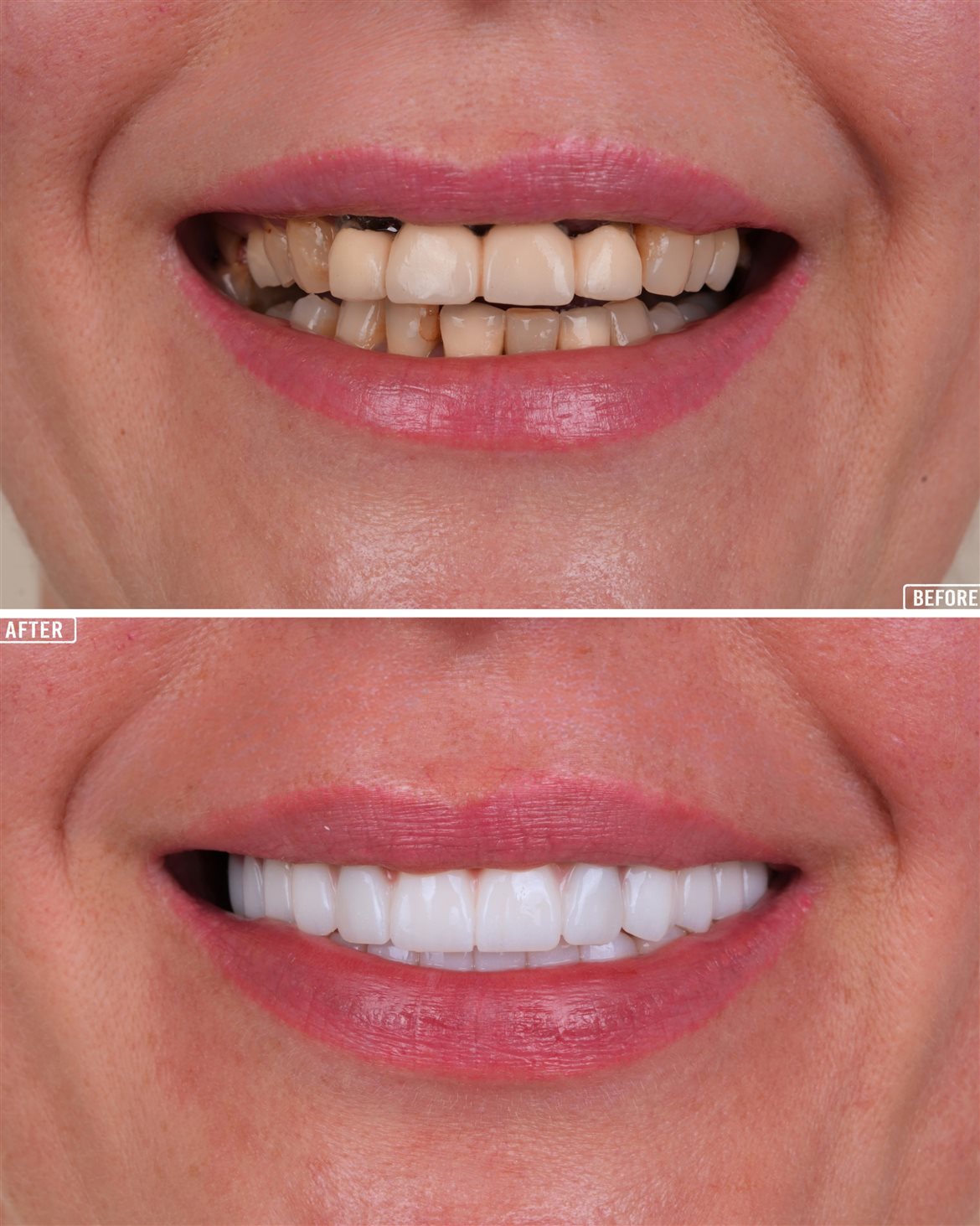 Full Mouth Crowns Before and After at Aesthetic Dental Turkey, Antalya