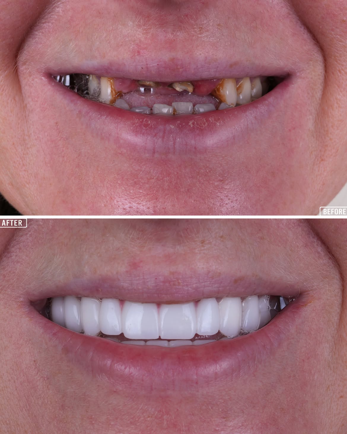 Full Mouth Restoration with Dental Implants Before and After in Antalya, Turkey