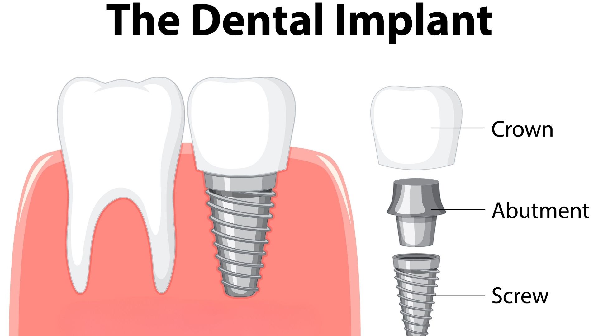 What is a dental implant? 