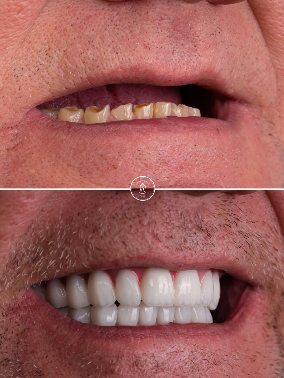 Dental Implants before and after-9