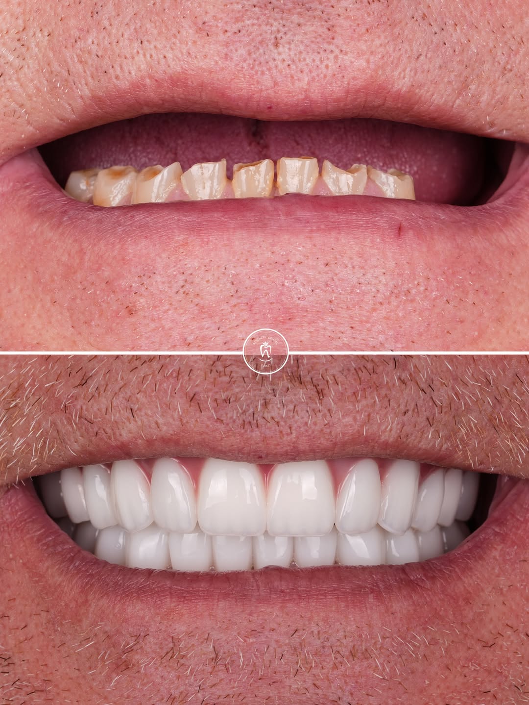Dental Implants before and after-10