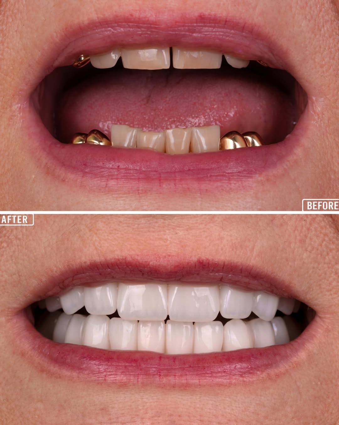 Dental Implants before and after-1