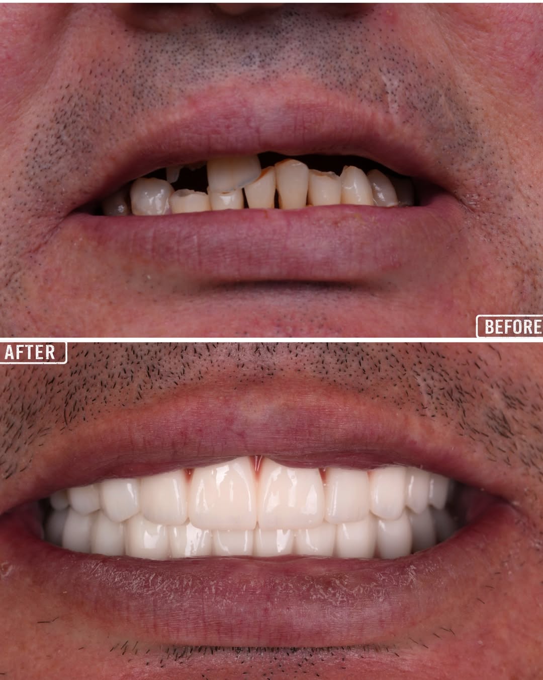Dental Implants before and after-4