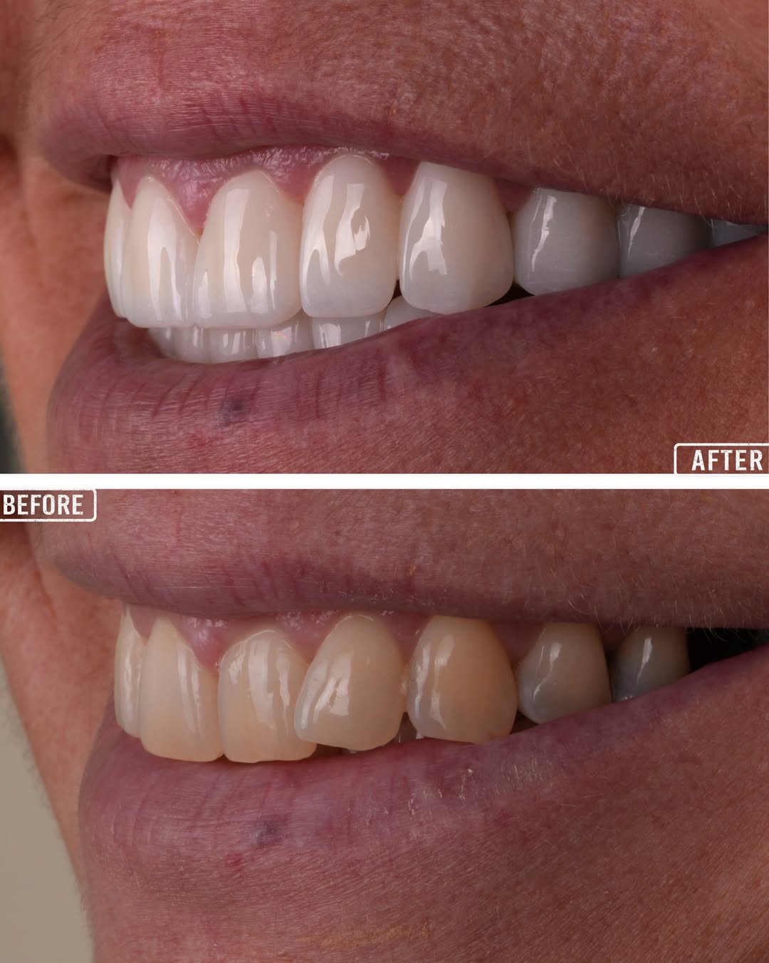 Dental Implants before and after-6