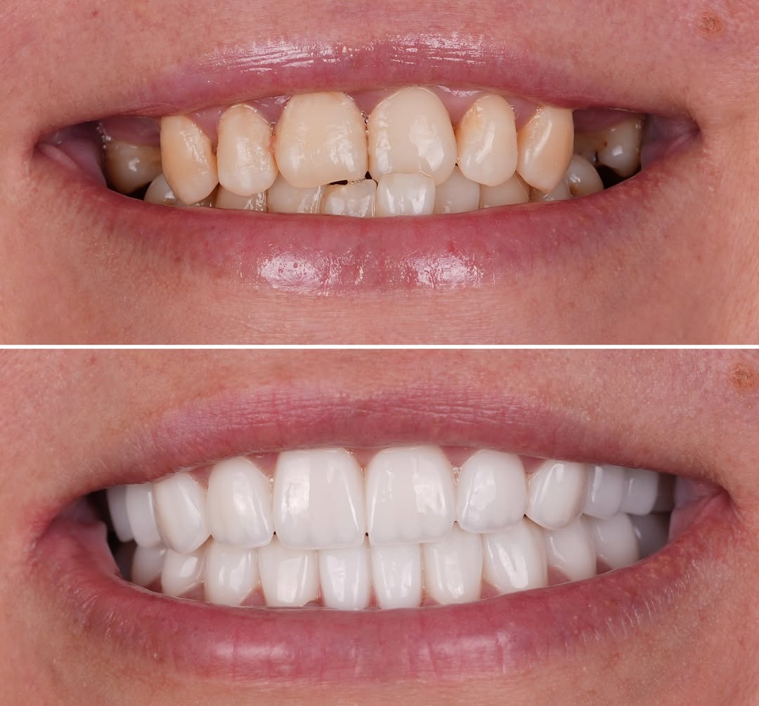 Dental Implants before and after-7