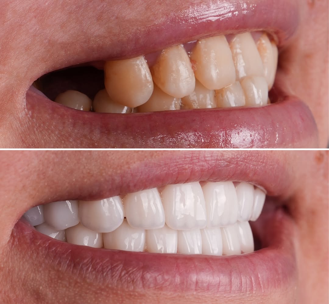 Dental Implants before and after-8