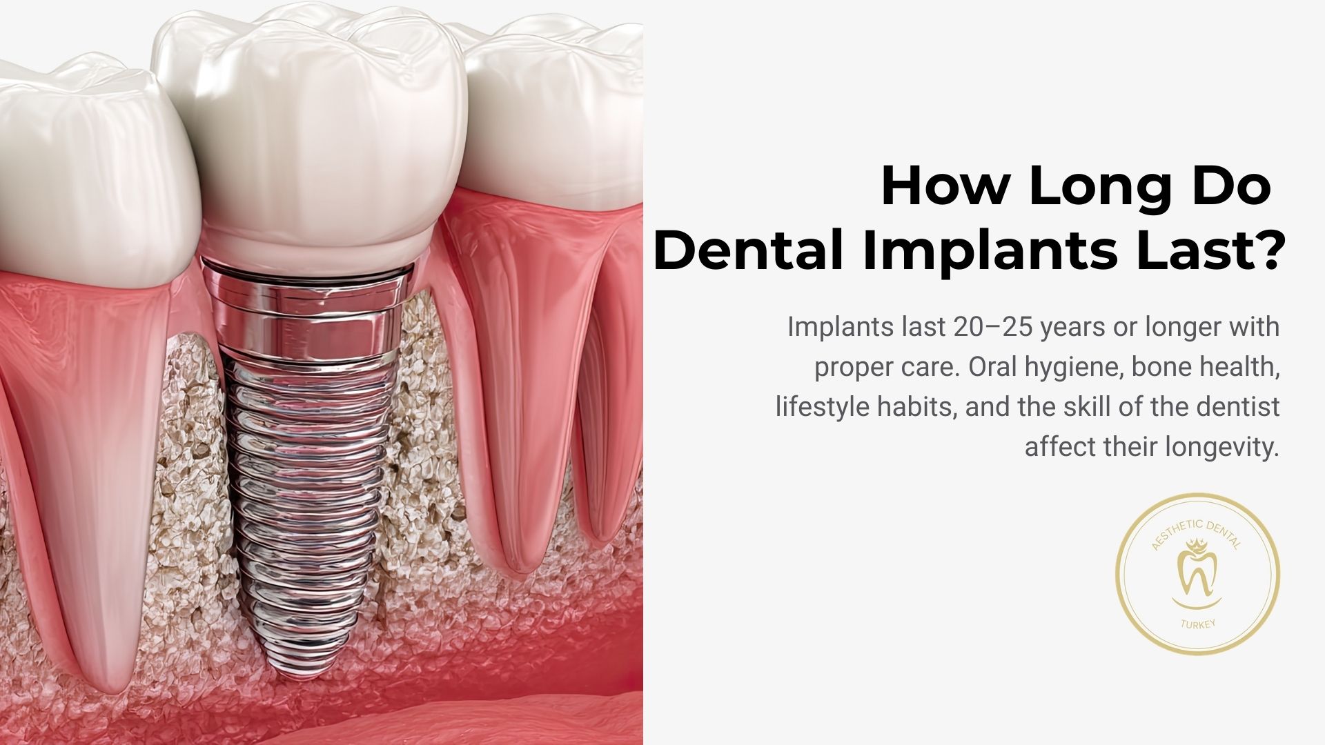 how-long-do-dental-implants-last?