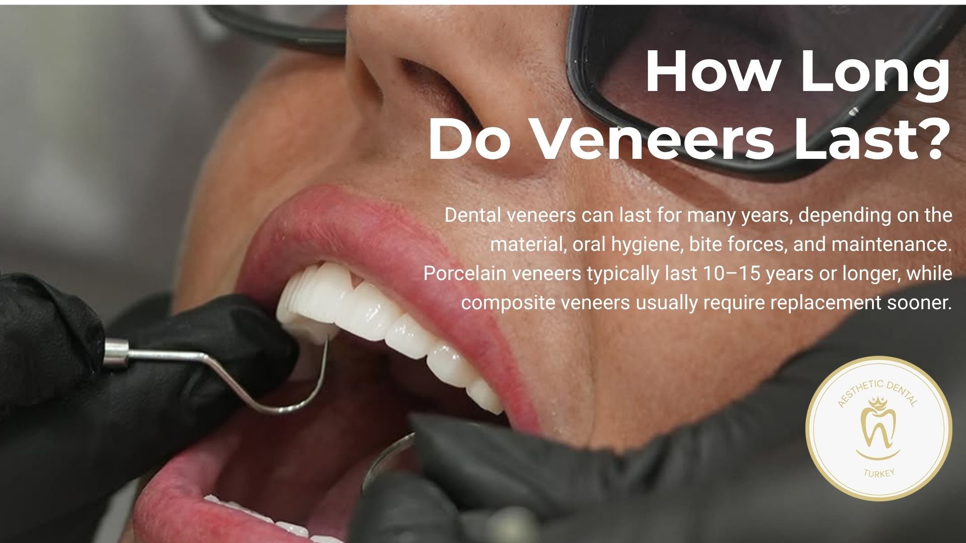 How long do veneers last?