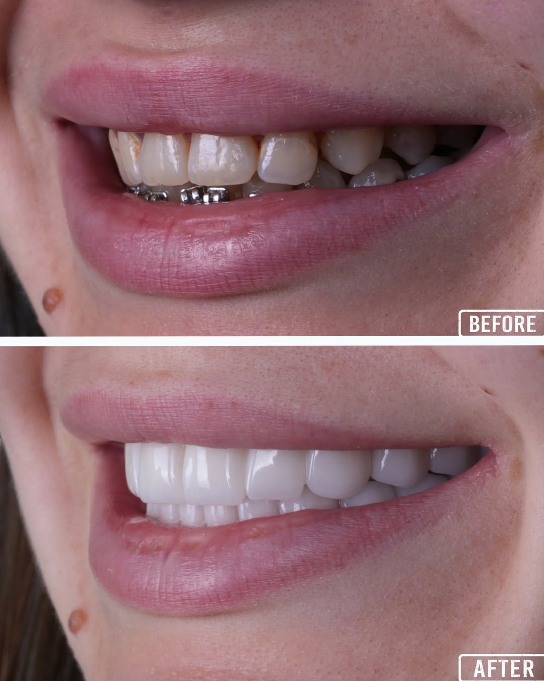 Treatments of Zirconia Crowns