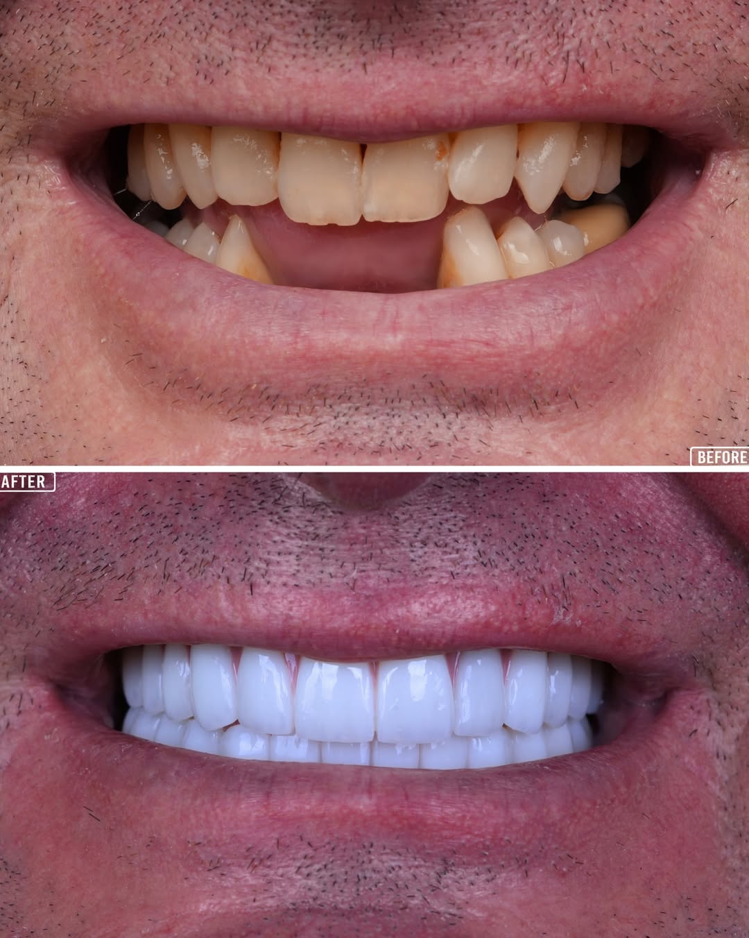 Dental Implants Turkey  