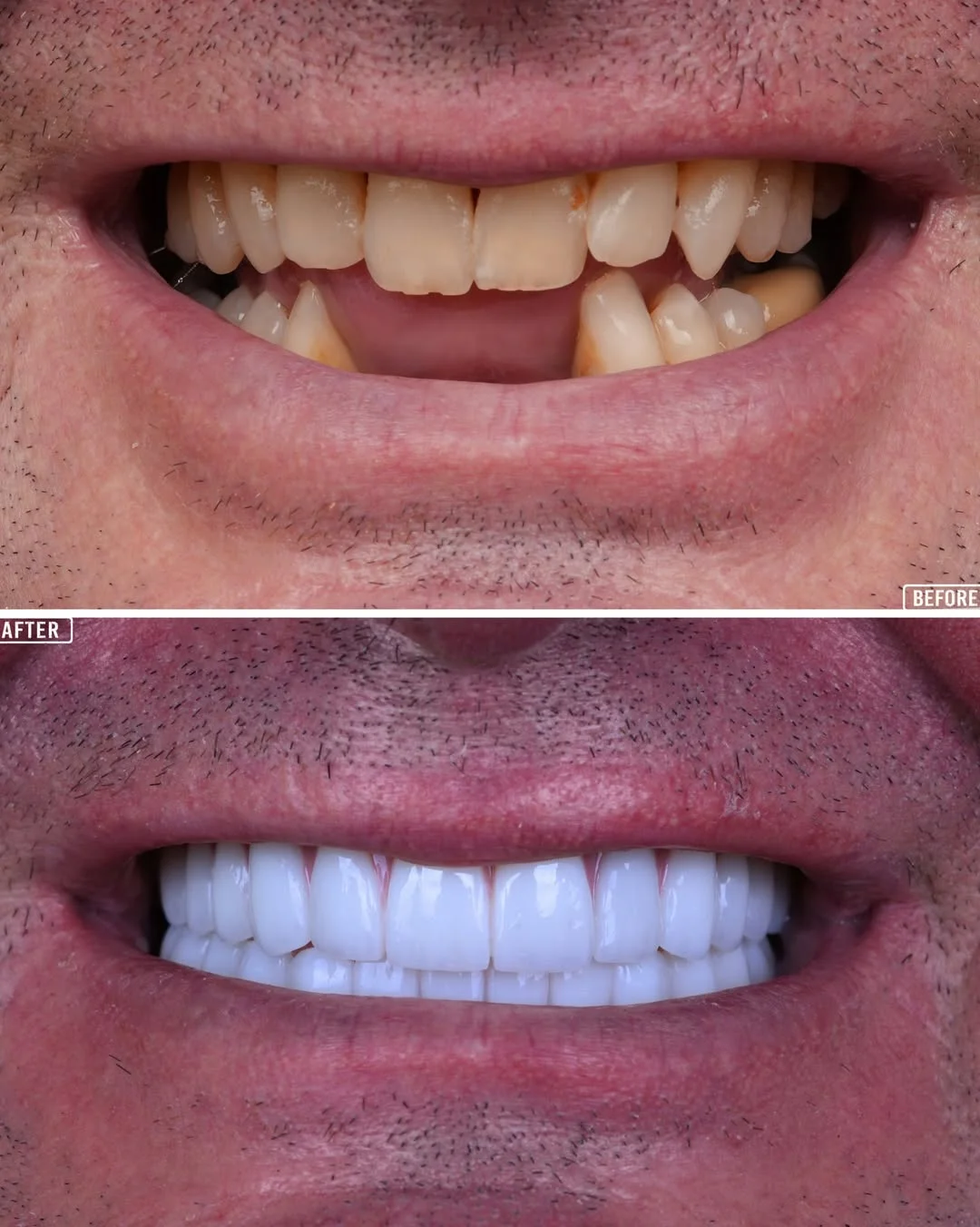 Dental Implants Turkey  