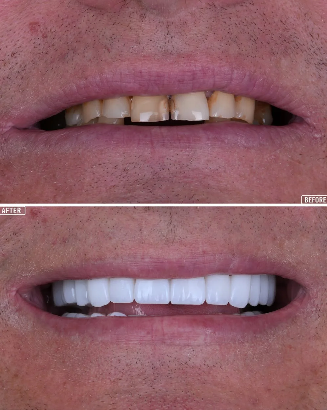 Smile Makeover Turkey  