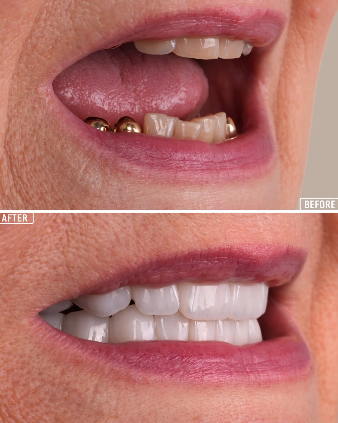 Dental Veneers and Crowns Turkey  