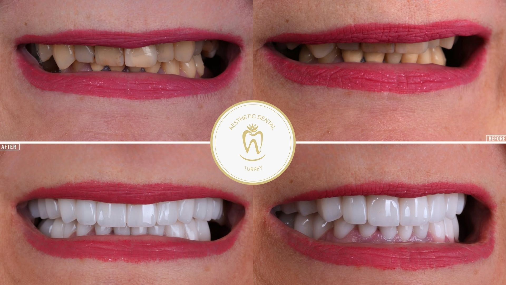 why-get-your-teeth-done-in-turkey?
