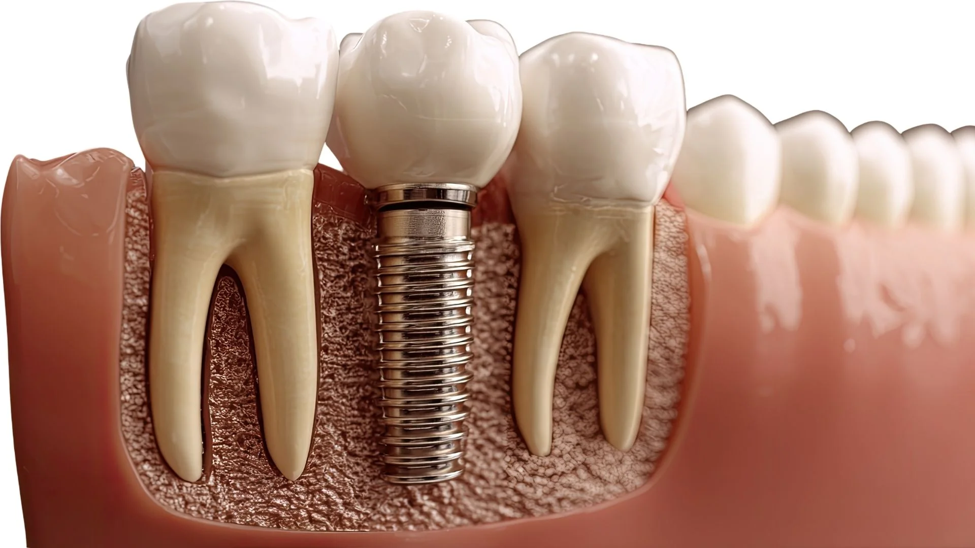 What is a dental implant?