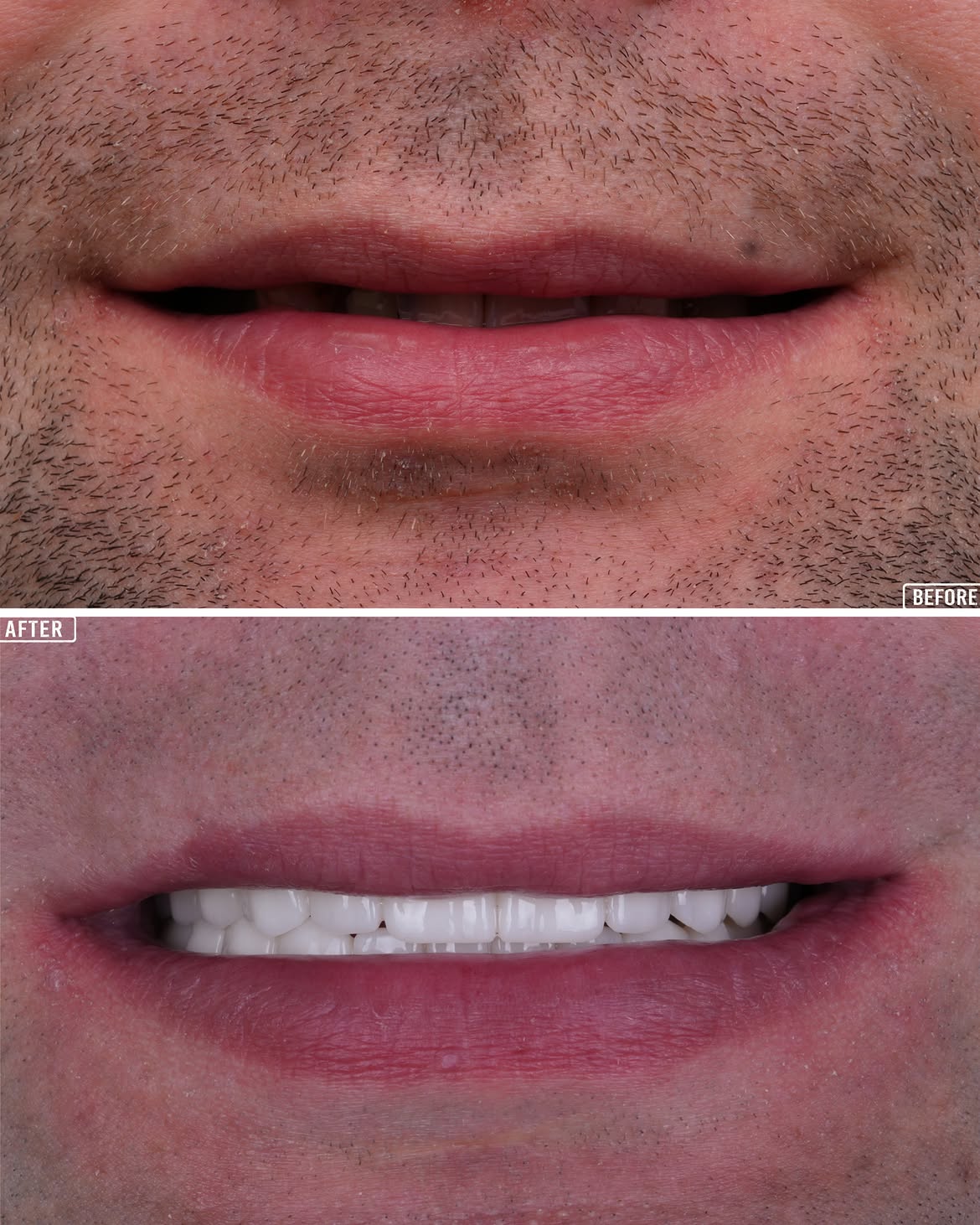 All on 6 Before & After in Antalya, Turkey 4