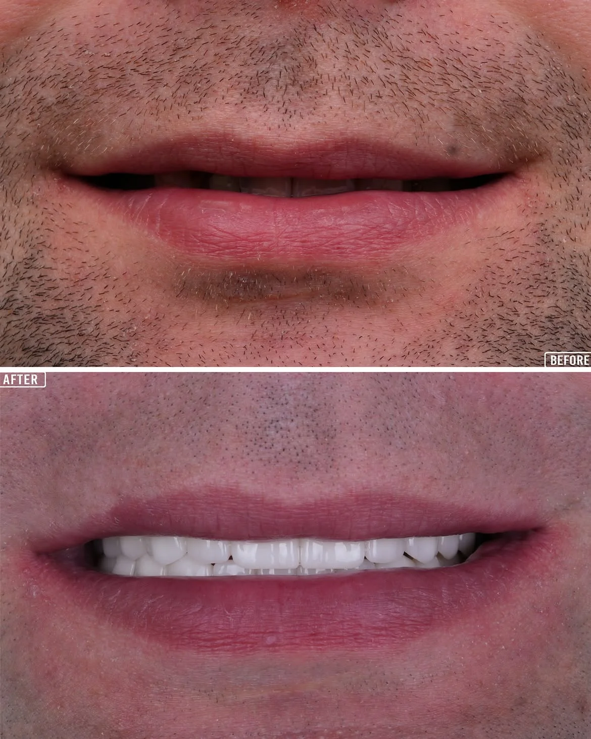 All on 6 Before & After in Antalya, Turkey 4