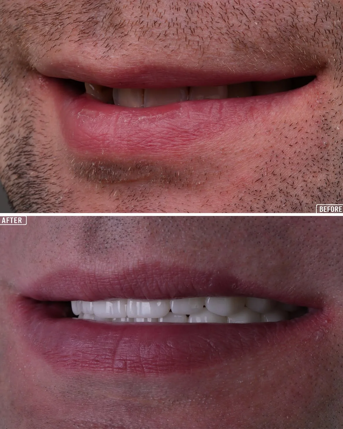 All on 6 Before & After in Antalya, Turkey 5
