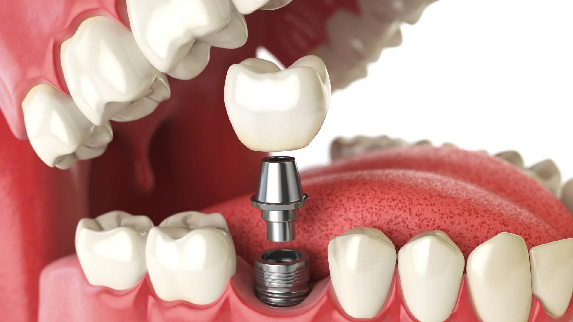 The importance of replacing a missing tooth