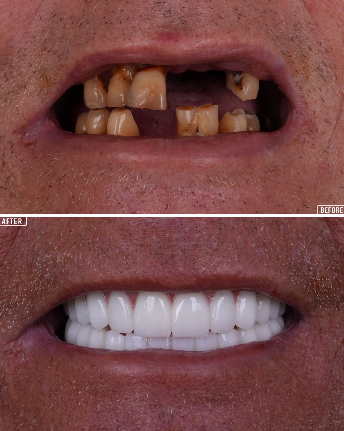 All on 4 Before & After in Antalya, Turkey 14