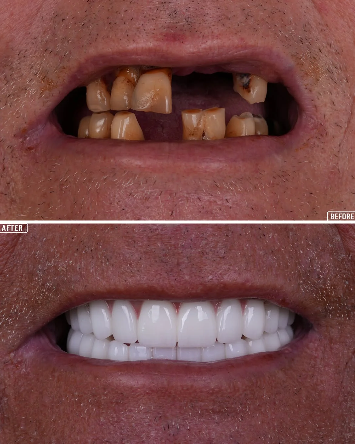 All on 4 Before & After in Antalya, Turkey 4
