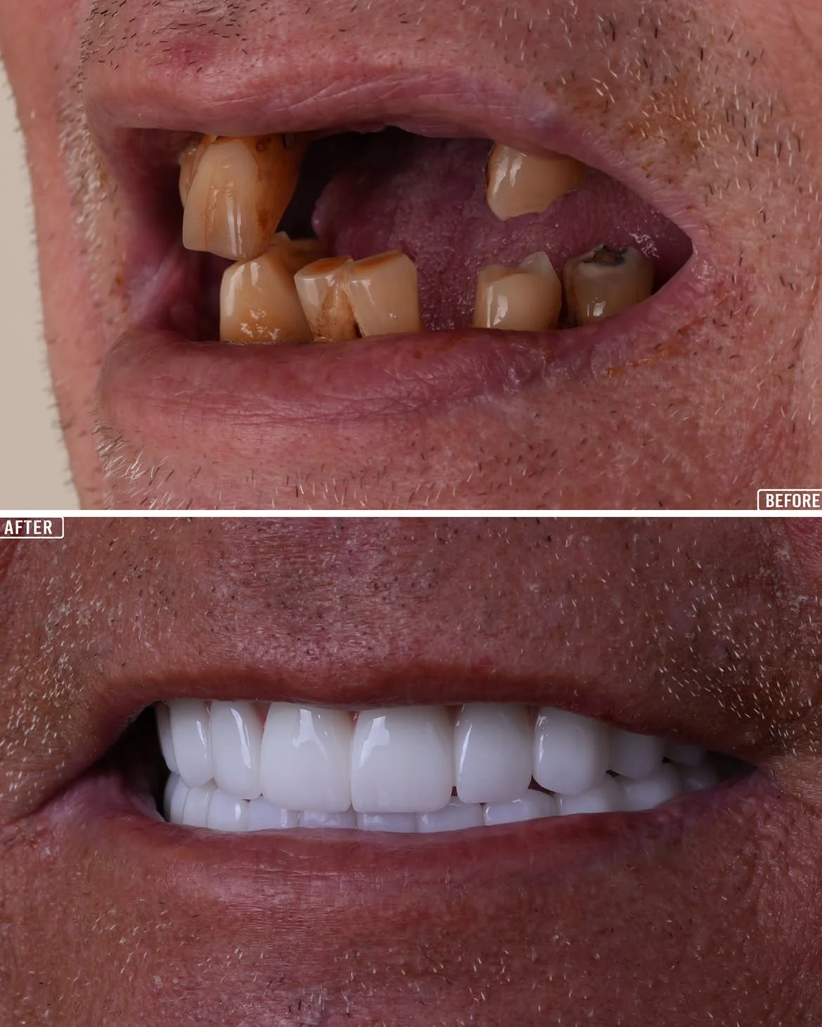 All on 4 Before & After in Antalya, Turkey 5