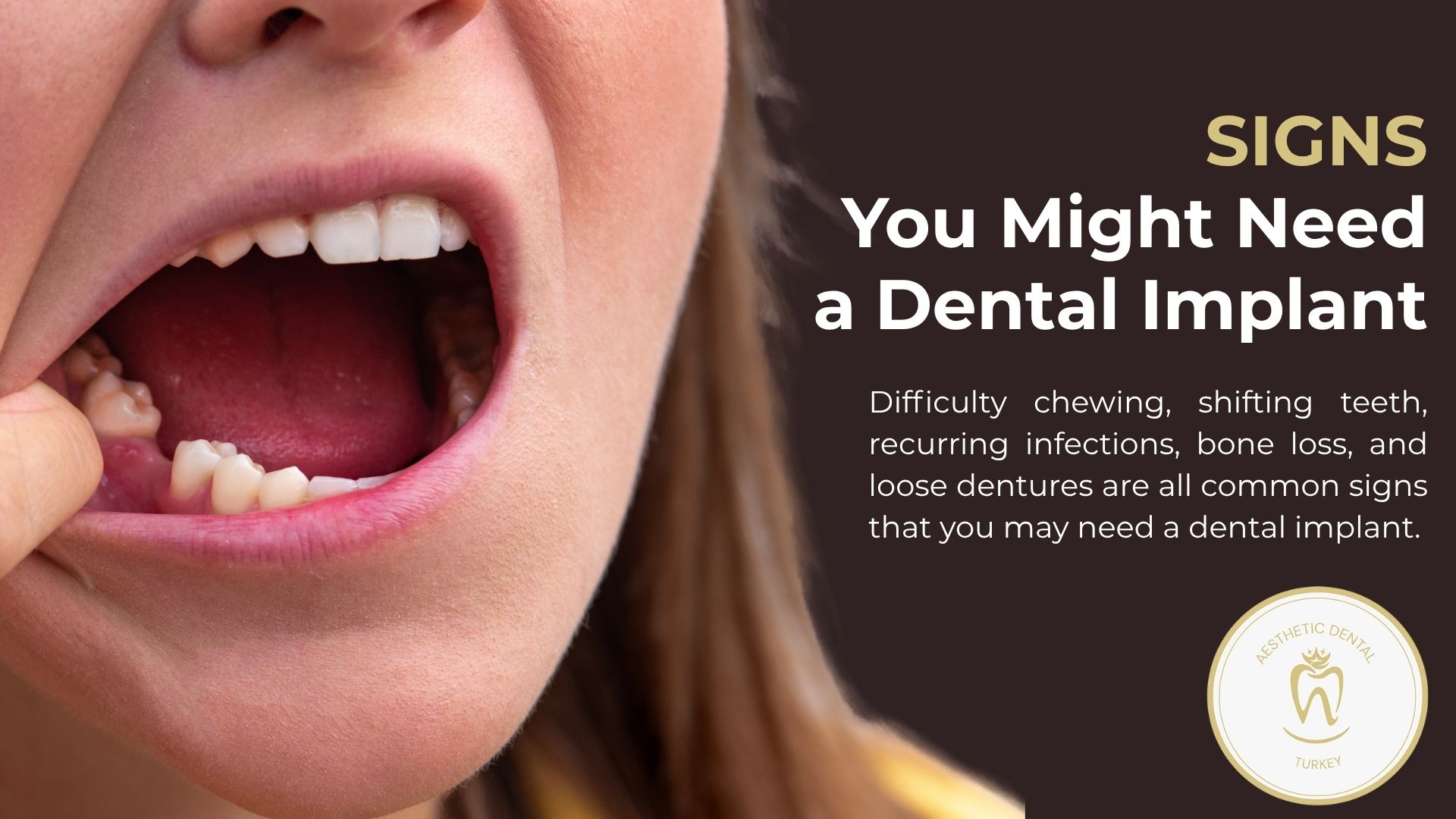 signs-you-need-dental-implant-turkey