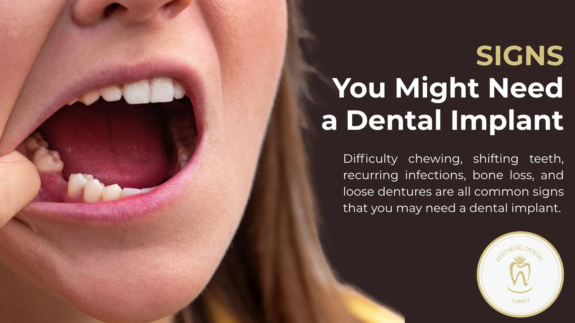 signs-you-need-dental-implant-turkey