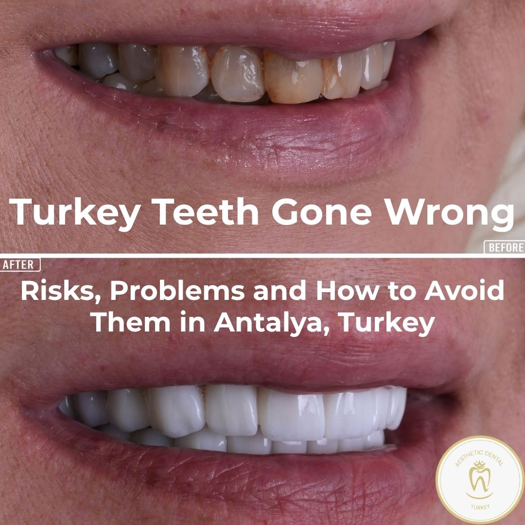 Turkey Teeth Gone Wrong: Risks and Problems