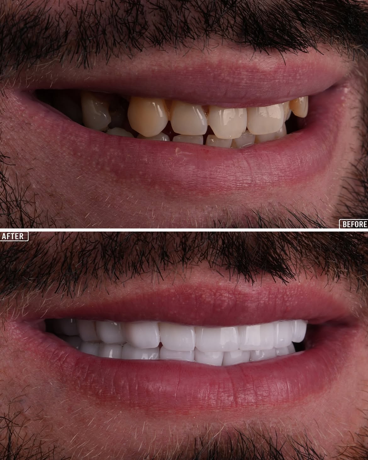 Turkey Teeth Veneers before and after 10