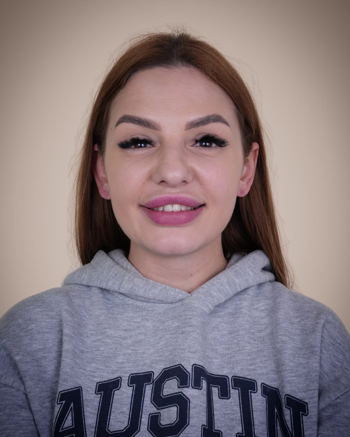 Turkey Teeth Veneers before and after 12